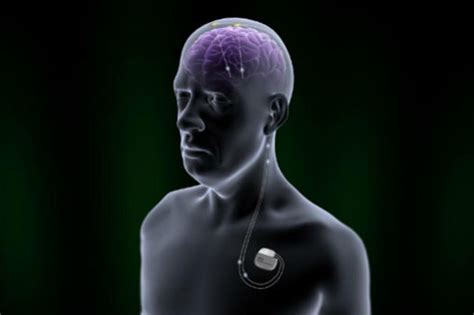 deep brain implant for parkinson's